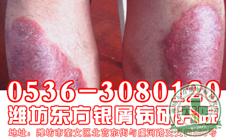 医生讲述：为什么那么多牛皮癣患者亲睐中医治疗