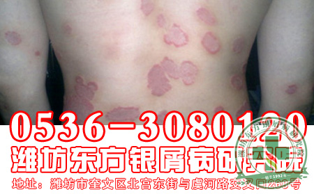 医生讲解   牛皮癣患者洗浴三禁忌
