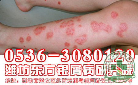 牛皮癣及时治疗很关键
