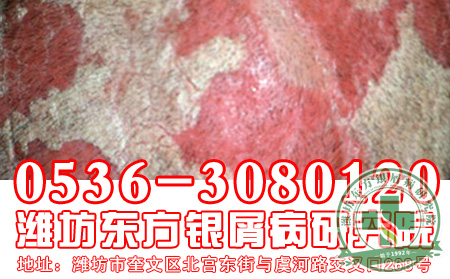 牛皮癣会不会致命呢？