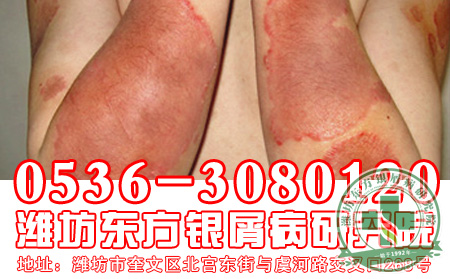 牛皮癣患者如何治疗