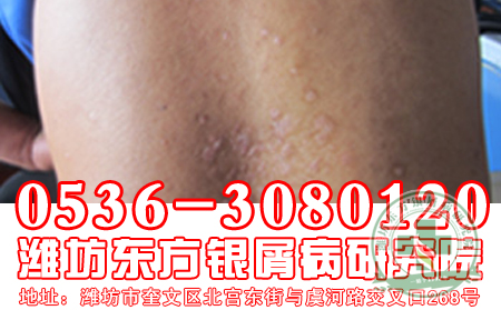 牛皮癣危害有哪些
