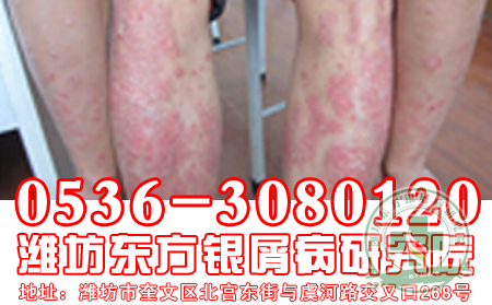 牛皮癣患者小心两种人