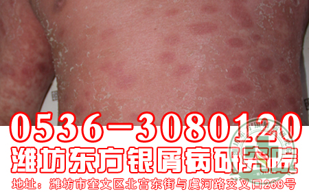 牛皮癣患者理想吃山竹吗？