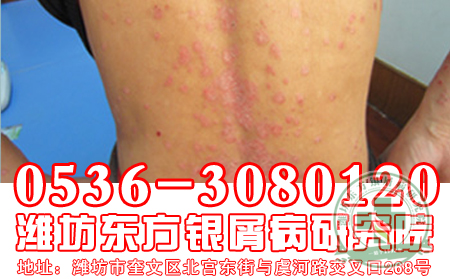 回顾每次恢复牛皮癣患者