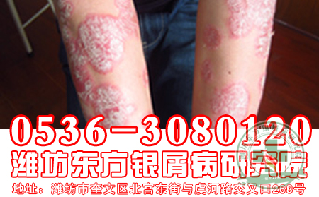食盐过多牛皮癣恢复的重大要害吗?
