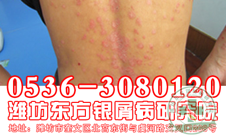 夏季牛皮癣治疗 佳时期