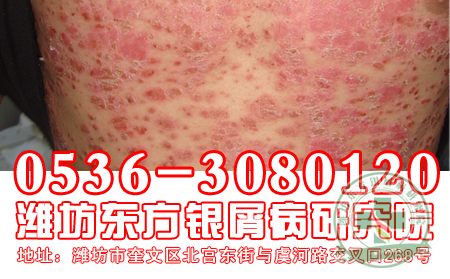 长期面对电脑会对牛皮癣患者带来哪些危害