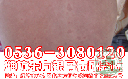 牛皮癣患者洗澡“四大”绝招