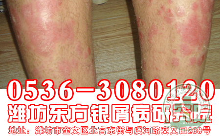 传染会不会是导致银屑病发病的诱因?