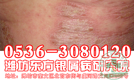 造成银屑病患者发病的诱因有哪些?