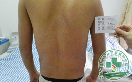 牛皮癣患者秋季如何抗感冒
