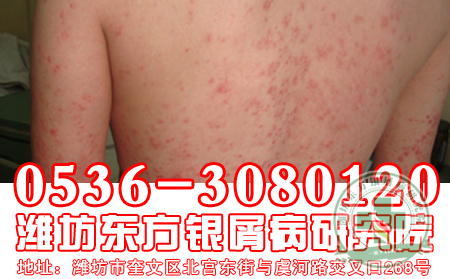 牛皮癣的治疗方法
