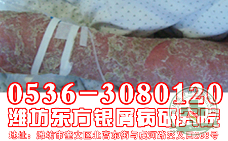 红皮型牛皮癣的症状
