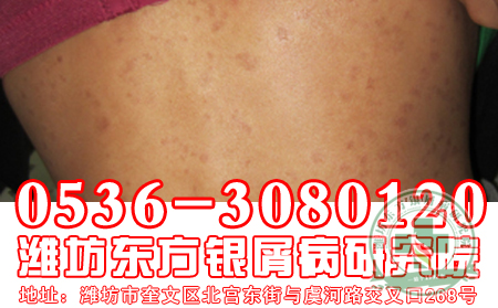 女性牛皮癣的症状