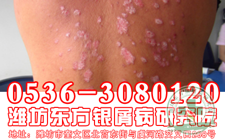 青少年牛皮癣的危害