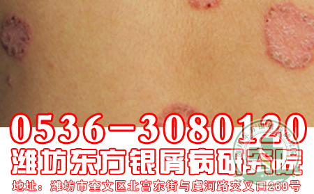 牛皮癣患者能吃什么不能吃什么