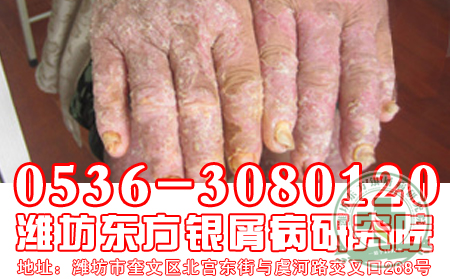 老年人要如何治疗牛皮癣？