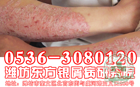 引起牛皮癣发作的原因有哪些？