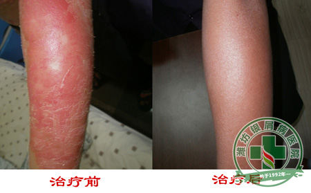 医生忠告：牛皮癣治疗不要走弯路