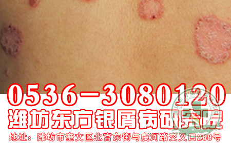 牛皮癣的治疗方法-辅助治疗