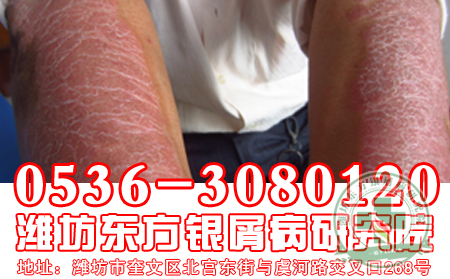 牛皮癣日常护理一定要注意