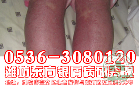 早期红皮型牛皮癣如何诊断