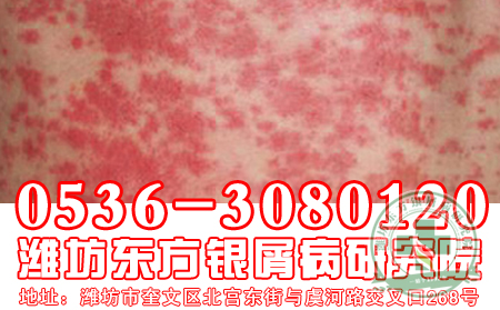 牛皮癣患者经常泡脚会对牛皮癣的治疗有辅助作用吗