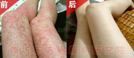 银屑病医院医生简述牛皮癣如何治疗方法理想健康