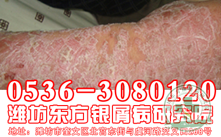 脓疱型牛皮癣怎么治疗?
