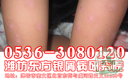 寻常型牛皮癣怎么治疗?