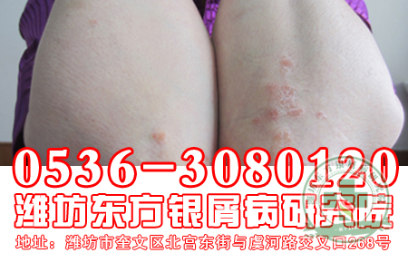 牛皮癣患者可不理想吃烧烤?