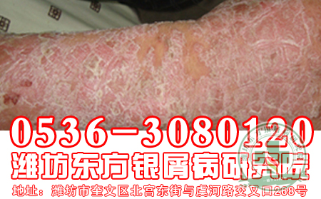 环境恶化也能引起牛皮癣?