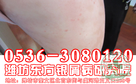 春季治疗银屑病理想时节