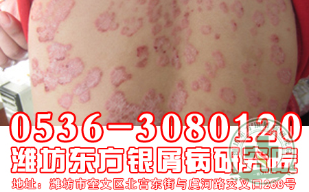 济南牛皮癣医院医生解析牛皮癣治疗有什么要求