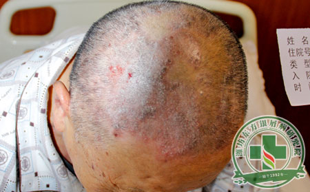 得了银屑病之后患者怎么办理想
