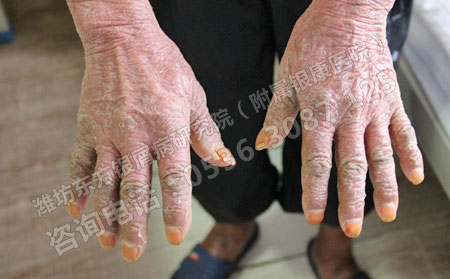 牛皮癣关节炎怎么治疗能治理想