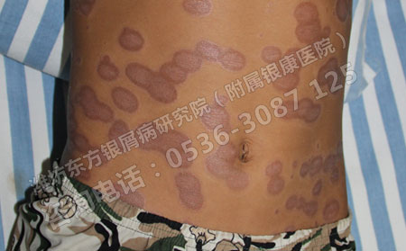 过年里银屑病患者更要有正确的就医观