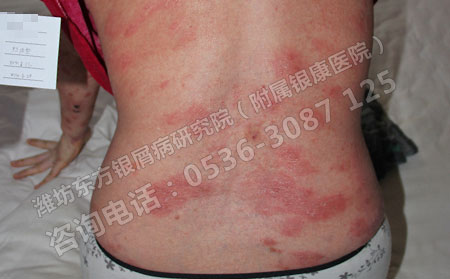 济南哪里治银屑病费用少