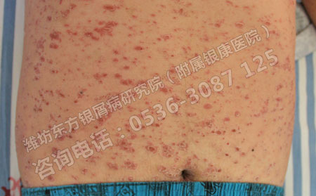 全身得了牛皮癣怎么治疗优势大