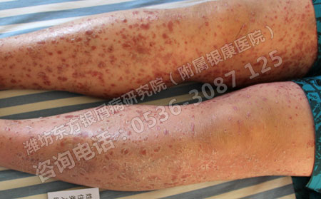 中医辨证讲述牛皮癣的治病原理