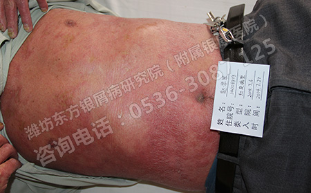 全身牛皮癣的护理办法是什么
