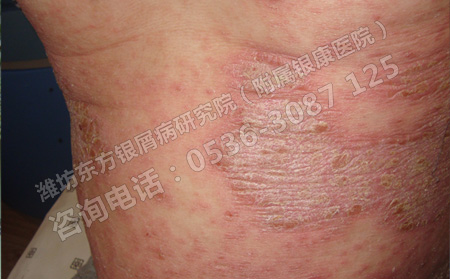 济南牛皮癣医院对患者治疗方面的建议