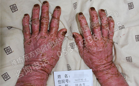 患了关节型牛皮癣怎样保健理想