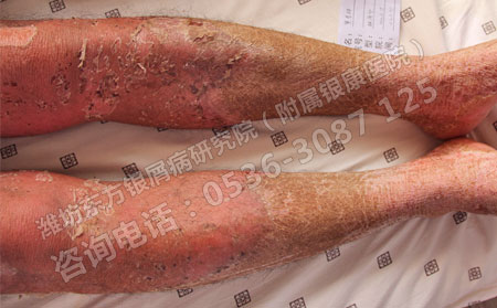 儿童牛皮癣如何治疗方法理想