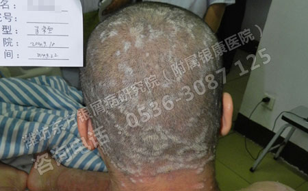 头面部银屑病的护理方法有哪些