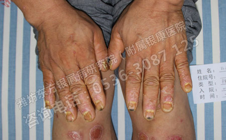 济南银屑病患者患者不能盲目求快