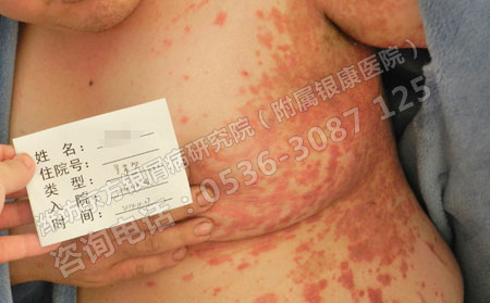 牛皮癣患者理想通过哪些方式护理自己的病情