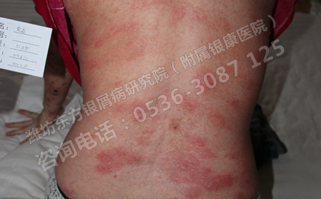 银屑病发生的原因是什么