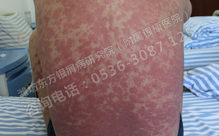 如何预防背部银屑病的发生